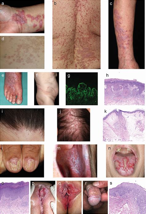 Genital Lichen Planus Images